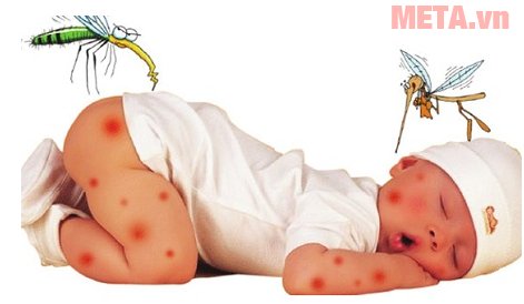Cách trị muỗi đốt cho bé