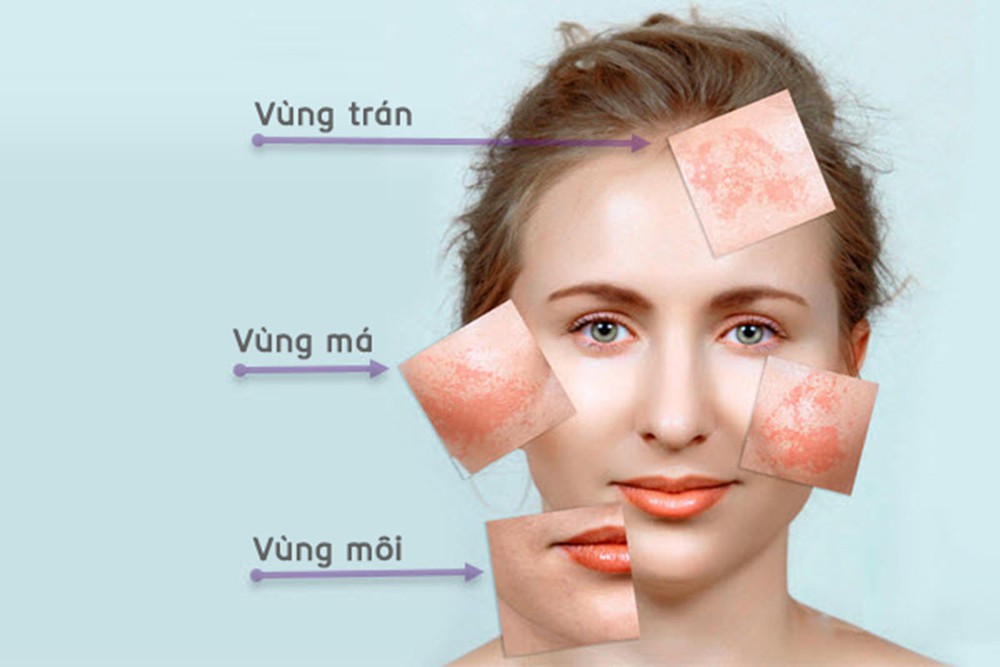 Melanin là gì? Melanin có phải là yếu tố gây nên nám không?