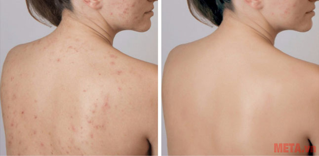 Làm thế nào để trị dứt điểm mụn lưng