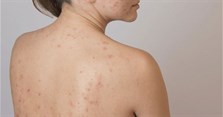 Để mụn lưng không còn là nỗi lo lắng của bạn