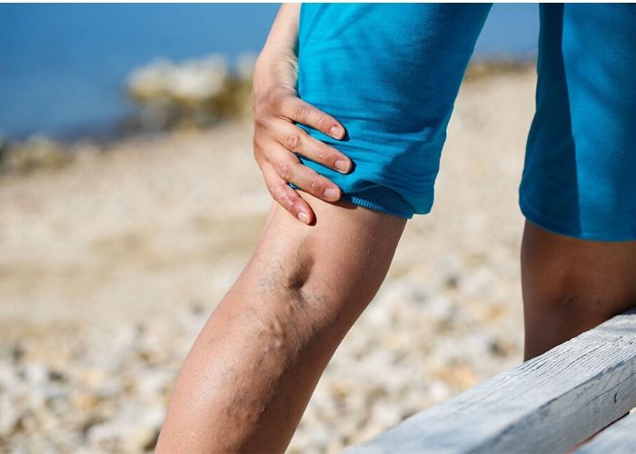 Bệnh suy giãn tĩnh mạch có nguy hiểm không? Bệnh suy giãn tĩnh mạch có nguy hiểm không?