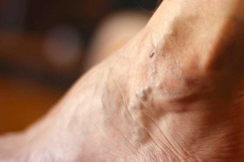 Tay chân nổi gân xanh thường là do tình trạng suy giãn tĩnh mạch gây ra Tay chân nổi gân xanh thường là do tình trạng suy giãn tĩnh mạch gây ra