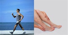 Bị giãn tĩnh mạch chân có tập thể dục, yoga, đi bộ, chạy bộ được không?