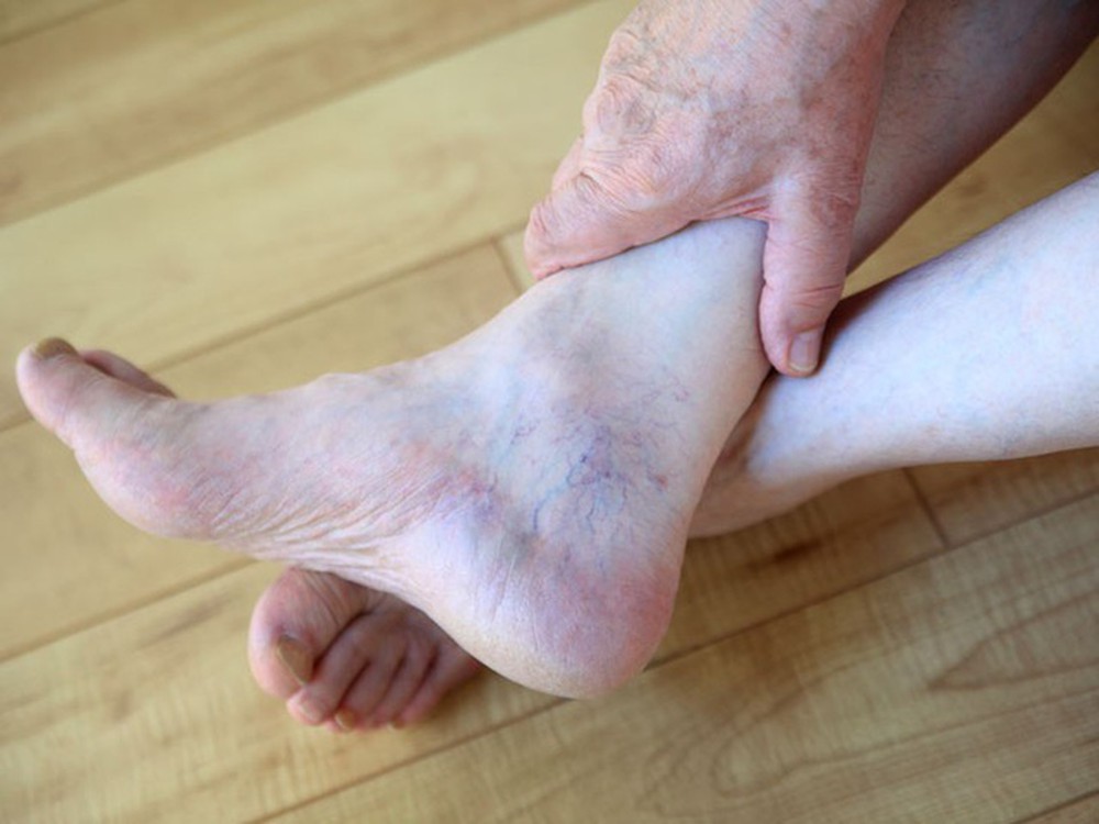 Giãn tĩnh mạch chân là một bệnh rất phổ biến hiện nay