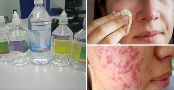 Nước muối sinh lý hỗ trợ điều trị mụn hiệu quả Nước muối sinh lý hỗ trợ điều trị mụn hiệu quả