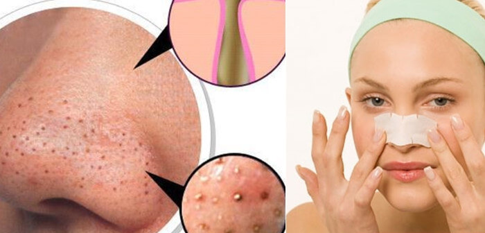 Mụn đầu đen là gì? Nguyên nhân gây mụn đầu đen