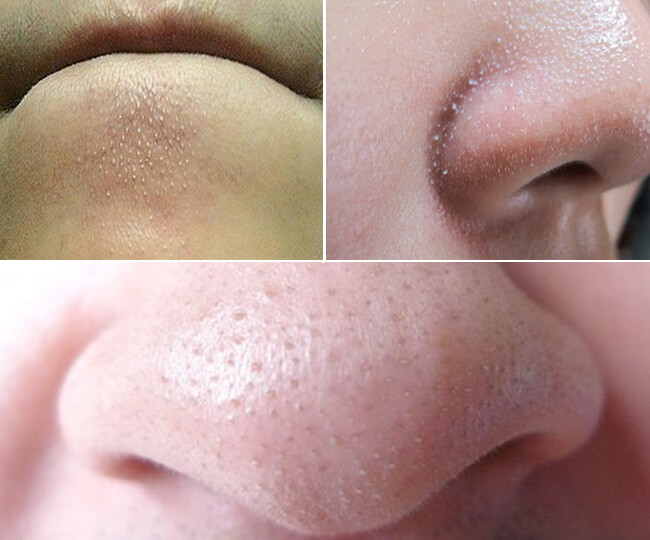 Sợi bã nhờn thường xuất hiện ở mũi và dưới cằm