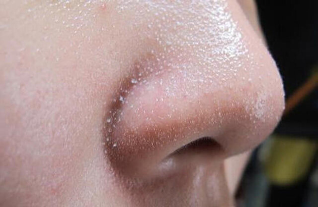 Người sở hữu làn da dầu thường có nhiều sợi bã nhờn