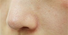 Sợi bã nhờn là gì? Cách trị sợi bã nhờn hiệu quả tại nhà