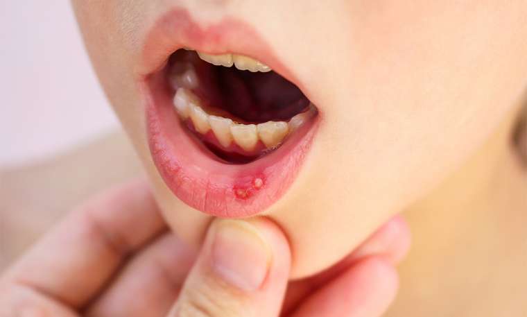 Bị nhiệt miệng là thiếu vitamin gì? Bị nhiệt miệng là thiếu vitamin gì?