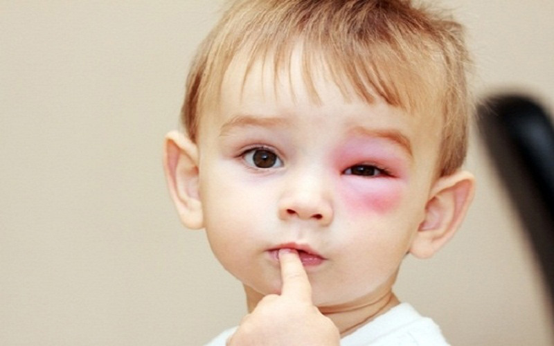 Bị ong đốt nên bôi gì cho nhanh khỏi