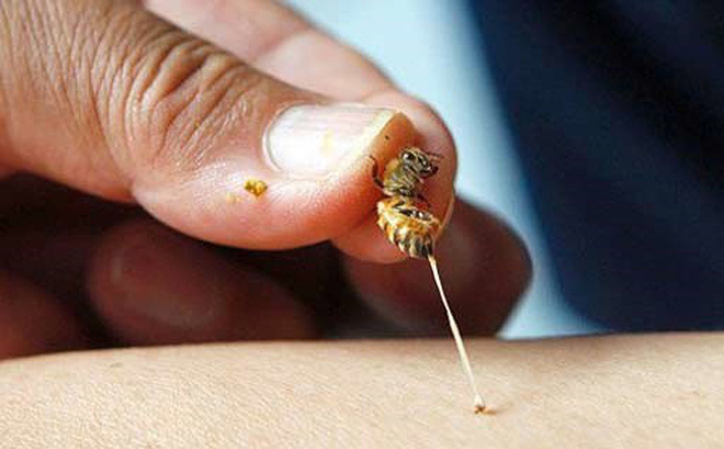 Cách sơ cứu nhanh khi mới bị ong đốt