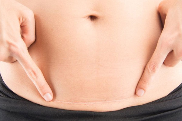Chăm sóc vết sẹo mổ