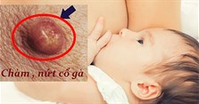 Nứt cổ gà là như thế nào? Cách chữa nứt cổ gà khi cho con bú
