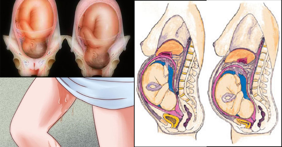Vỡ nước ối ở phụ nữ đang mang thai Vỡ nước ối ở phụ nữ đang mang thai