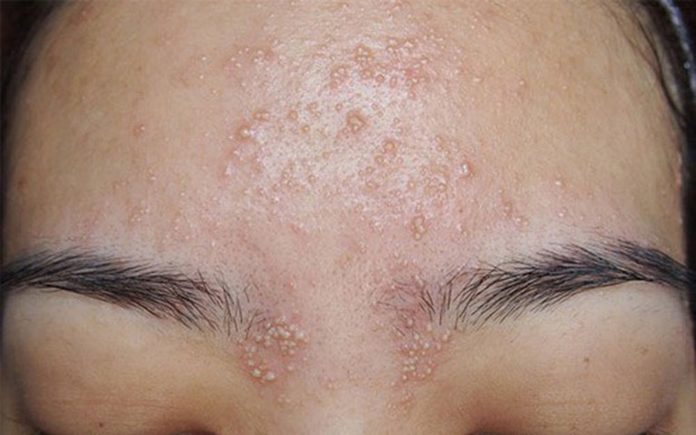 Nguyên nhân gây viêm lỗ chân lông mặt Nguyên nhân gây viêm lỗ chân lông mặt