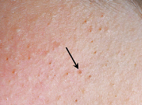 Nguyên nhân và dấu hiệu mắc viêm nang lông vùng kín