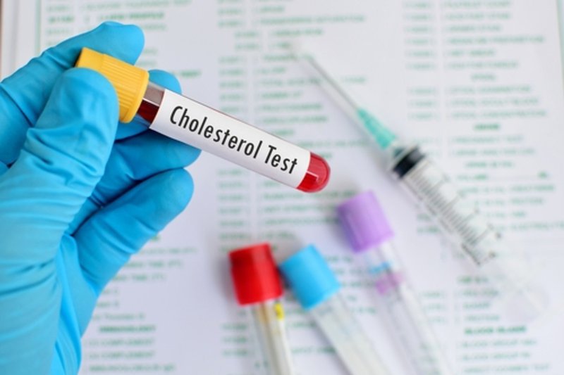 Xét nghiệm cholesterol là gì?