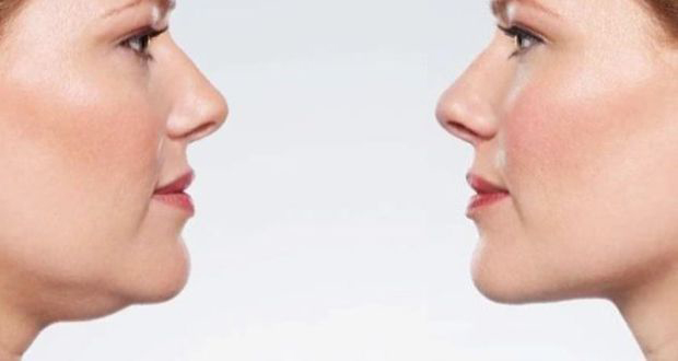 Nguyên nhân gây nọng cằm Nguyên nhân gây nọng cằm