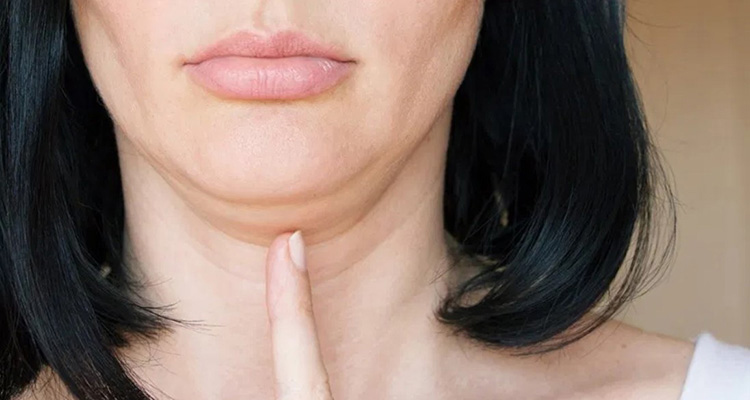 Dấu hiệu nhận biết nọng cằm Dấu hiệu nhận biết nọng cằm