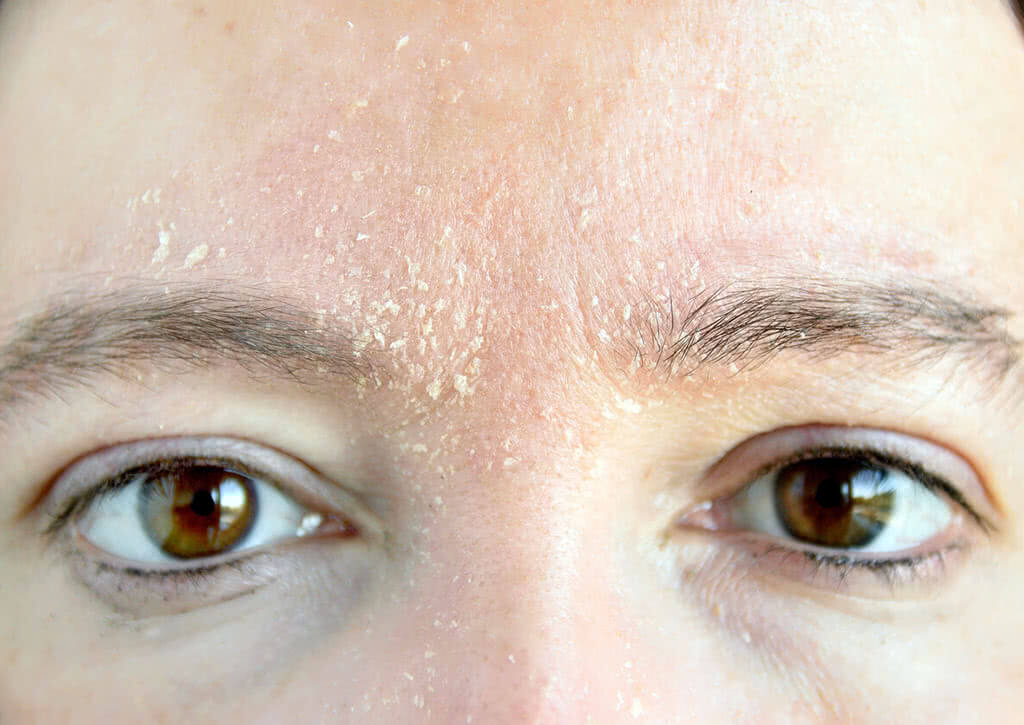 Nguyên nhân da mặt hay bị khô nứt nẻ vào mùa đông