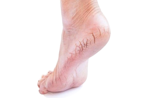 Nguyên nhân gây nứt gót chân