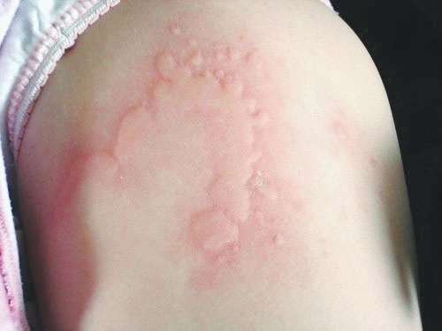 Bị sâu róm đốt bôi gì