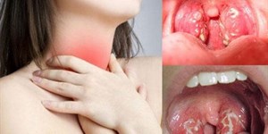 Viêm họng có lây không? Nguyên nhân, triệu chứng viêm họng