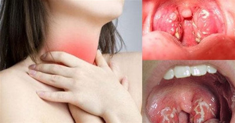 Viêm họng có lây không? Nguyên nhân, triệu chứng viêm họng