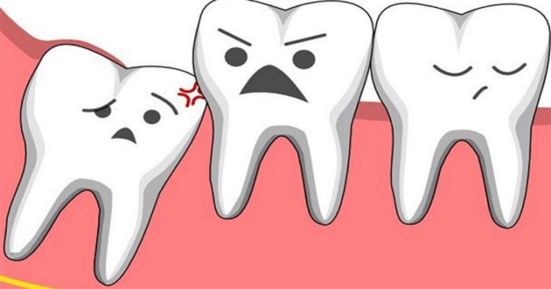 Răng khôn là gì? Răng khôn là răng số mấy?