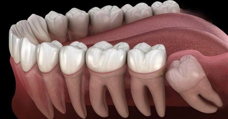 Răng số 8 là răng gì, có nên nhổ không? Nhổ răng số 8 có đau không?