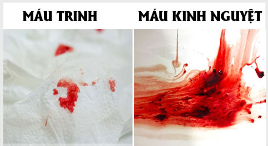Phân biệt máu trinh và máu kinh nguyệt Phân biệt máu trinh và máu kinh nguyệt