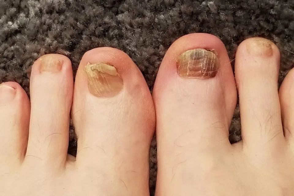 Móng chân móng tay