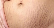 Cách trị rạn da sau sinh cho bà bầu tại nhà hiệu quả nhất
