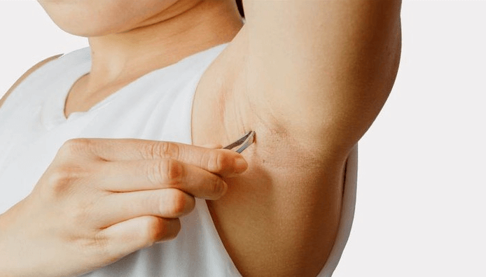 Nguyên nhân lông mọc ngược Nguyên nhân lông mọc ngược