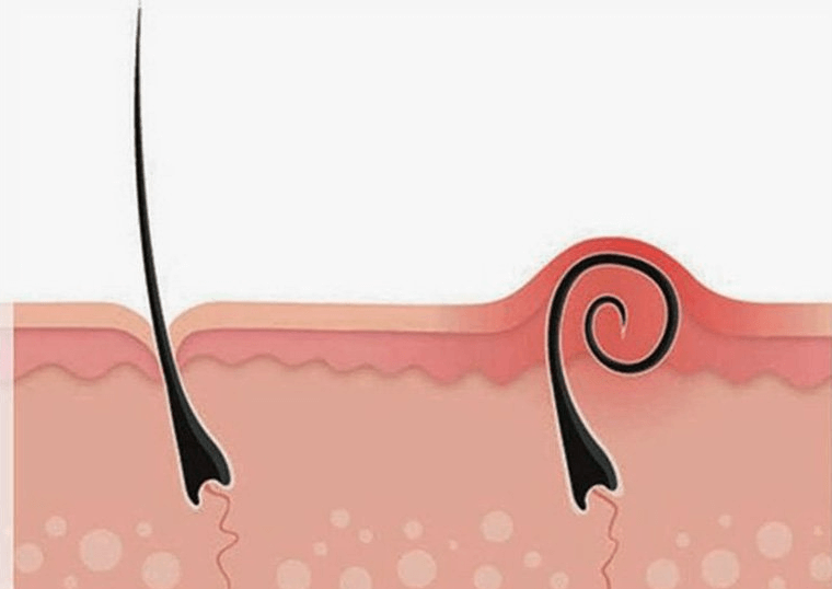 Lông mọc ngược là gì? Lông mọc ngược là gì?