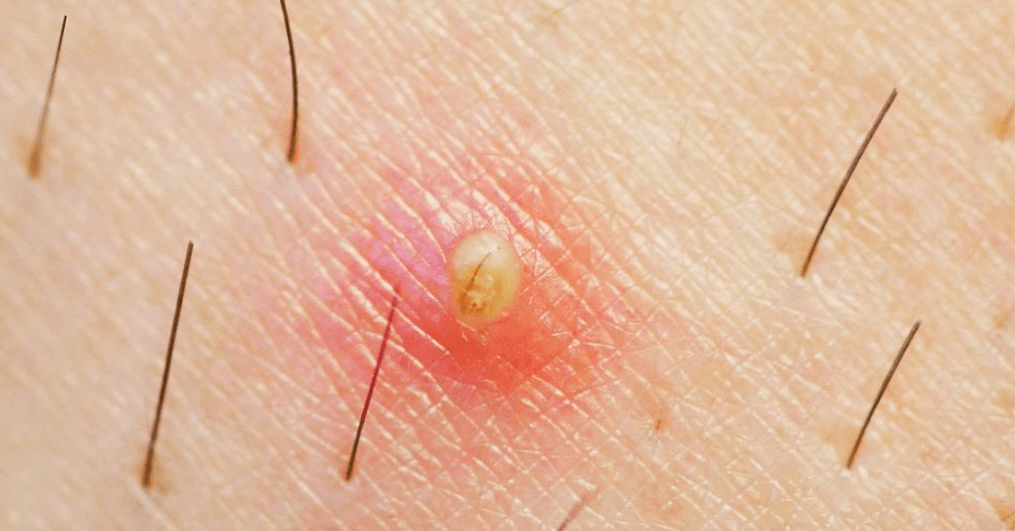 Biểu hiện của lông mọc ngược Biểu hiện của lông mọc ngược