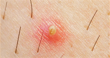 Cách trị và phòng tránh lông mọc ngược hiệu quả nhất