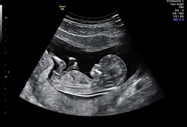 Cách tính ngày dự sinh chính xác bằng siêu âm Cách tính ngày dự sinh chính xác bằng siêu âm