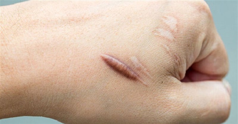 13 Cách trị sẹo lồi hiệu quả từ sẹo mới đến sẹo lâu năm