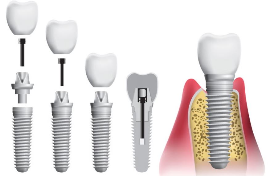 Cấu tạo implant