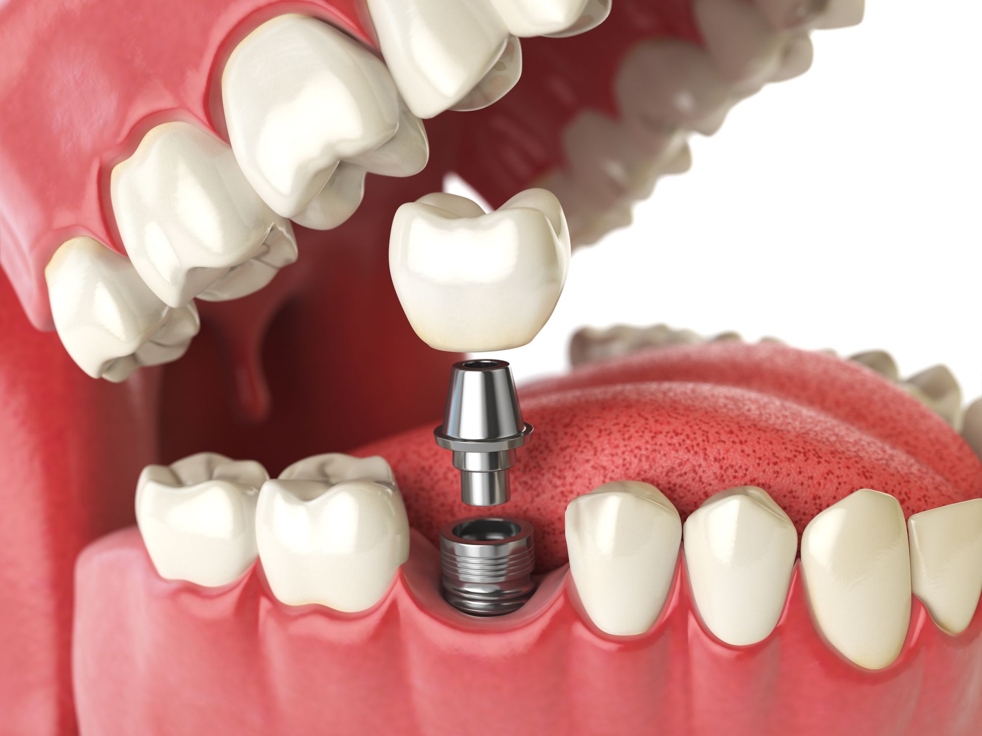Cấy ghép implant là gì, có đau không?