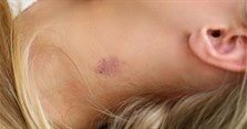 Hickey là gì, có nguy hiểm không? Cách làm mờ vết hickey