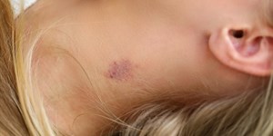 Hickey là gì, có nguy hiểm không? Cách làm mờ vết hickey