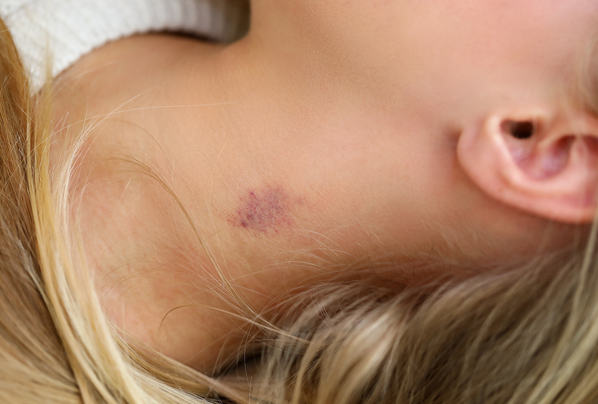 Hickey là gì?