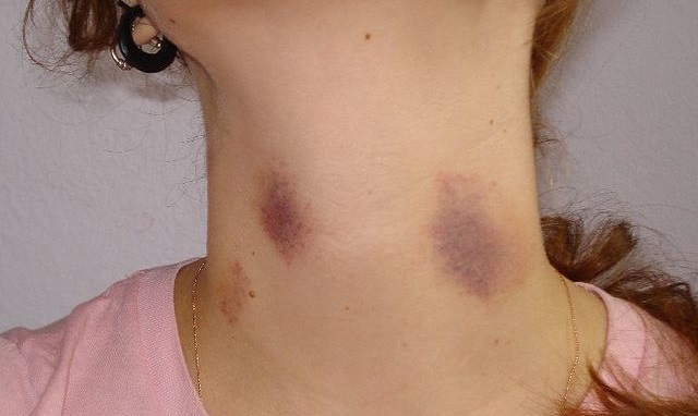 Hickey có nguy hiểm không? Hickey có nguy hiểm không?