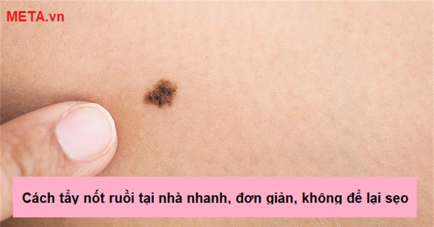 Cách tẩy nốt ruồi tại nhà nhanh, đơn giản, không để lại sẹo