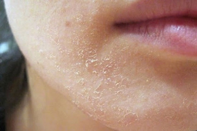 Tác dụng phụ của Tretinoin Tác dụng phụ của Tretinoin