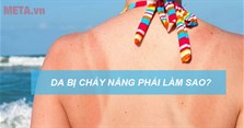 Da bị cháy nắng phải làm sao? Cách chữa da bị cháy nắng tại nhà