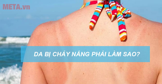 Da bị cháy nắng phải làm sao Da bị cháy nắng phải làm sao